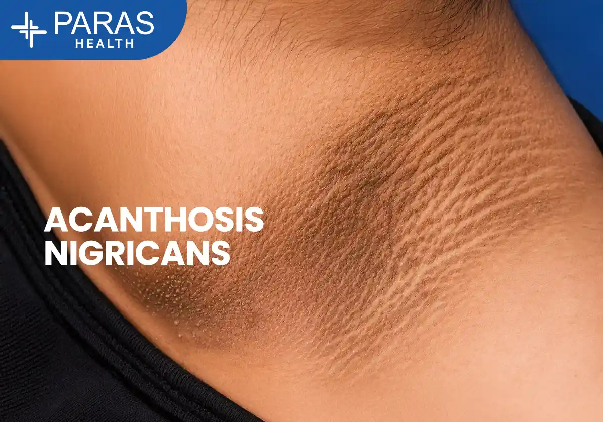 Acanthosis Nigricans